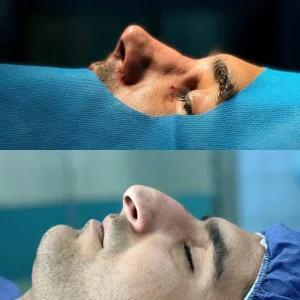 تصاویر رینوپلاستی بلافاصله بعد از عمل