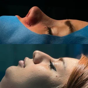 تصاویر رینوپلاستی بلافاصله بعد از عمل