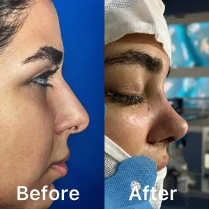 تصاویر رینوپلاستی بلافاصله بعد از عمل