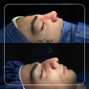 تصاویر رینوپلاستی بلافاصله بعد از عمل