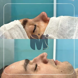 تصاویر رینوپلاستی بلافاصله بعد از عمل