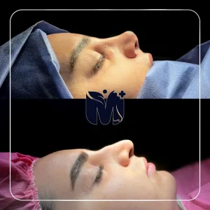 تصاویر رینوپلاستی بلافاصله بعد از عمل