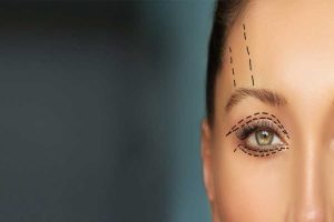 بلفاروپلاستی و تاثیر آن بر بهبود بینایی