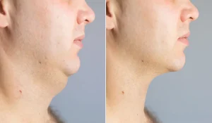 زمان مناسب انجام لیپوفیس به چه مواردی بستگی دارد؟