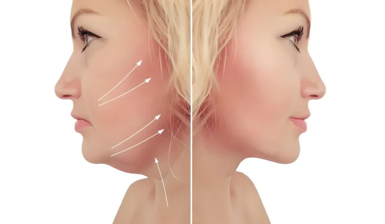 چهره‌ای جذاب‌تر با لیپوفیس! چگونه امکان پذیر است؟