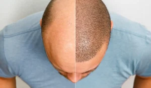 حفظ نتایج کاشت مو در طولانی مدت به رعایت چه نکاتی وابسته است؟