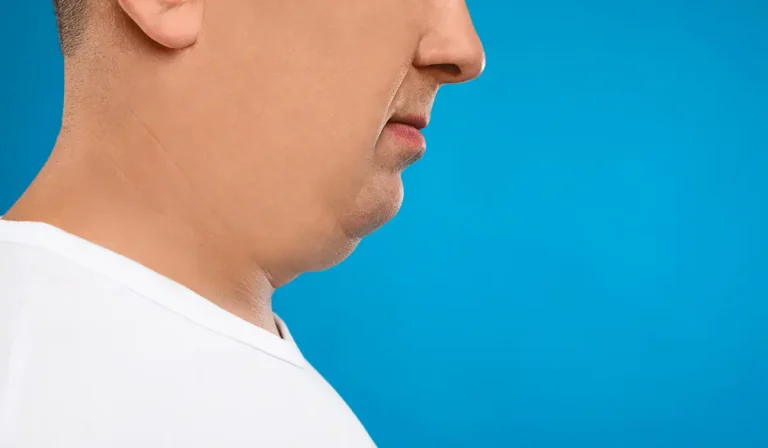 روش‌های حذف چربی غبغب : لیپوساکشن در مقابل گزینه‌های غیرجراحی