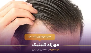 مقایسه روشهای کاشت مو : کدام روش مناسب شما است؟