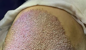 کاشت مو به روش FUE : فرایند، مزایا و نکات مهم