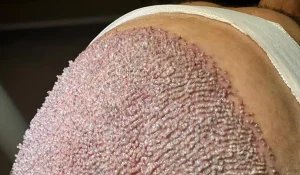 کاشت مو به روش FIT : چه تکنیکی است و چه مراحلی دارد؟