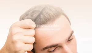 کاشت مو به روش SUT : چه مراحلی دارد و نیازمند چه مراقبتهایی است؟