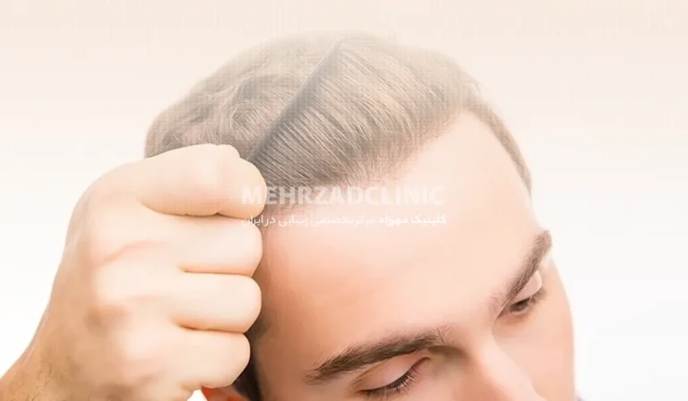 کاشت مو به روش SUT : چه مراحلی دارد و نیازمند چه مراقبت‌هایی است؟