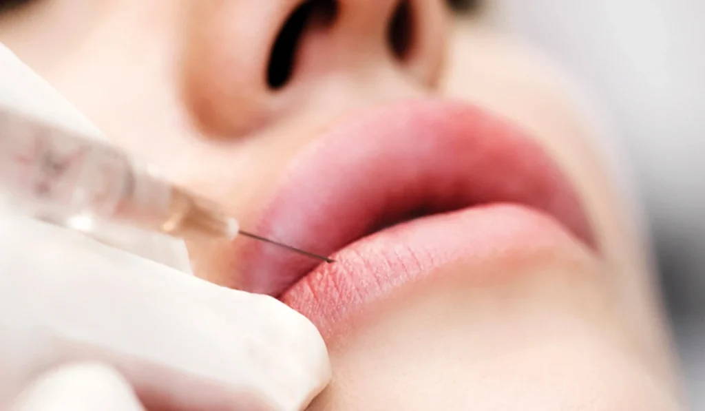 تزریق ژل به لب : بهترین جنس ژل و روش تزریق کدام است؟