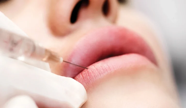 تزریق ژل به لب : بهترین جنس ژل و روش تزریق کدام است؟