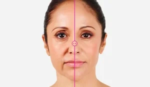 روشهای درمان خط خنده : برای رسیدن به چهره ای بدون چین و چروک