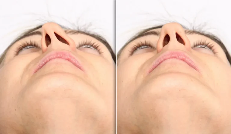 تفاوت رینوپلاستی و سپتوپلاستی در چیست؟