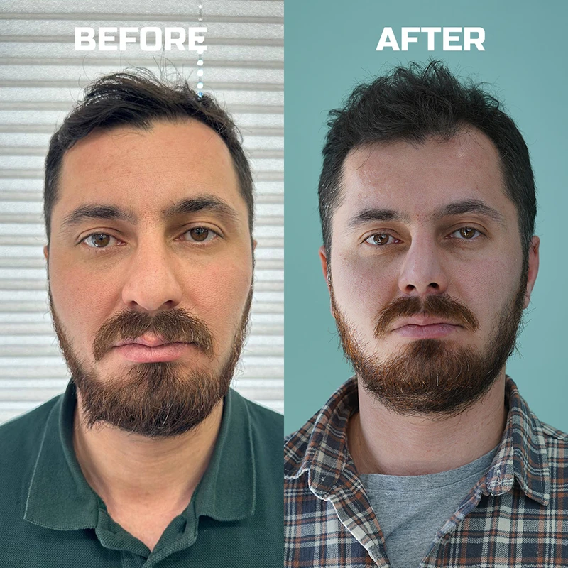 جراحی بینی گوشتی کلینیک مهرزاد