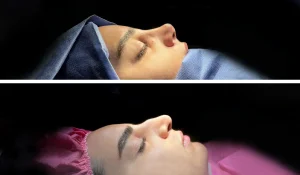 جراحی بینی استخوانی : روش‌های مخصوص عمل این فرم بینی