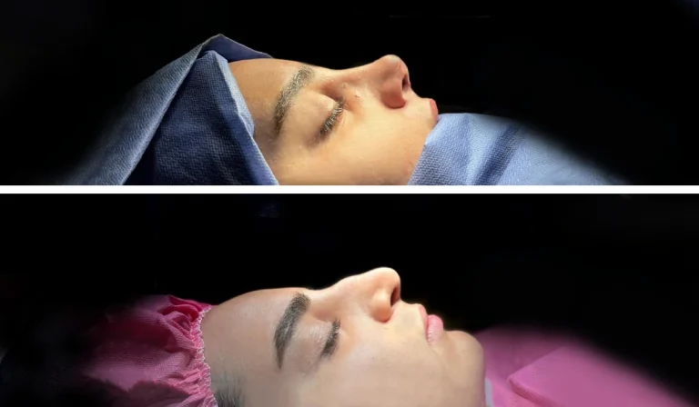 جراحی بینی استخوانی : روش‌های مخصوص عمل این فرم بینی