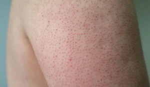 پوست مرغی چیست و چگونه درمان می شود؟