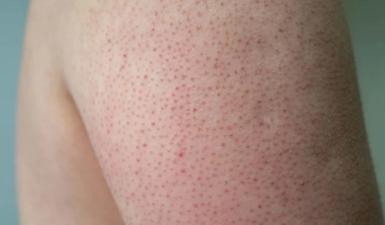 پوست مرغی چیست و چگونه درمان می شود؟