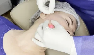 اندولیفت خط خنده : سفت شدن پوست و کاهش عمق خطوط خنده