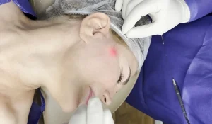 اندولیفت پلک : روشی نوین برای جوانسازی و لیفت پلکها