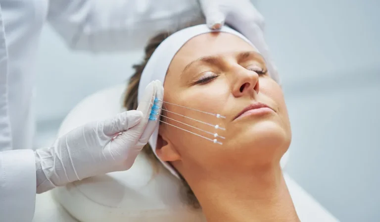 لیفت صورت با نخ : روش، مزایا و مراقبت‌های پس از آن