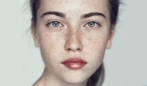 روشهای درمان کک و مک : علتهای ایجاد آن چیست؟