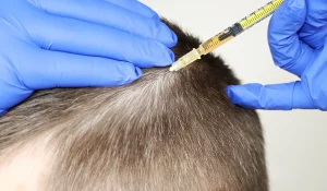 درمان ریزش موی سر : روشهای دارویی ، رژیم و جراحی