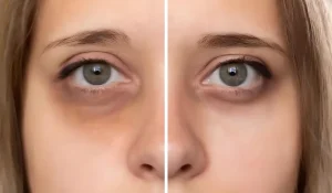 درمان دائمی گودی زیر چشم : چگونه برای همیشه از این مشکل رها شوید؟