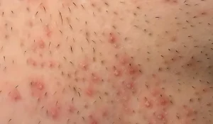 جوش بعد از اصلاح ناحیه تناسلی : چرا و چگونه پیشگیری کنیم؟