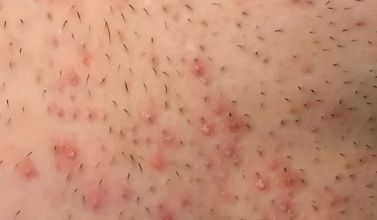 جوش بعد از اصلاح ناحیه تناسلی : چرا و چگونه پیشگیری کنیم؟