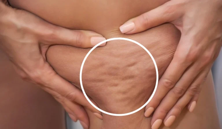 روشهای درمان سلولیت : پوست ناصاف و گودی‌دار ناشی از تجمع بافت چربی