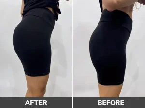 تصاویر قبل و بعد از فیلر بادی