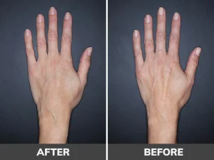 تصاویر قبل و بعد از فیلر بادی