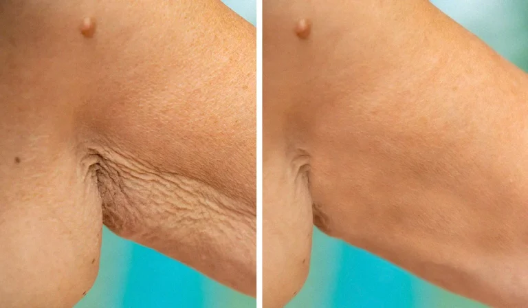 لیفت بازو (Brachioplasty) : برای شکل‌دهی و بهبود ظاهر بازوها