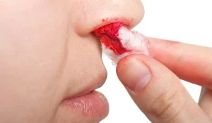 خونریزی بعد از عمل بینی چگونه مدیریت کنیم؟