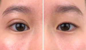 پلک دو تایی : آیا نوعی زیبایی است؟ دلایل و نحوه درمان آن چگونه است؟