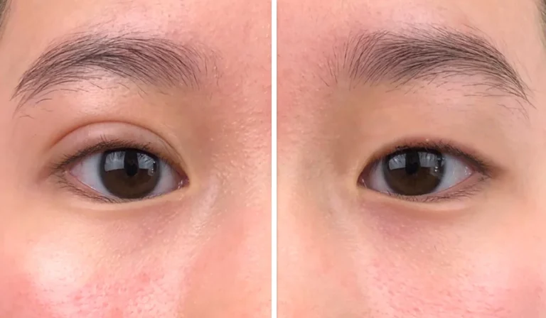 پلک دو تایی : آیا نوعی زیبایی است؟ دلایل و نحوه درمان آن چگونه است؟
