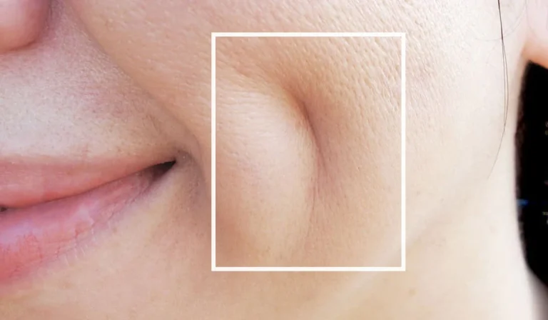 ایجاد چال گونه با جراحی چگونه انجام می شود؟