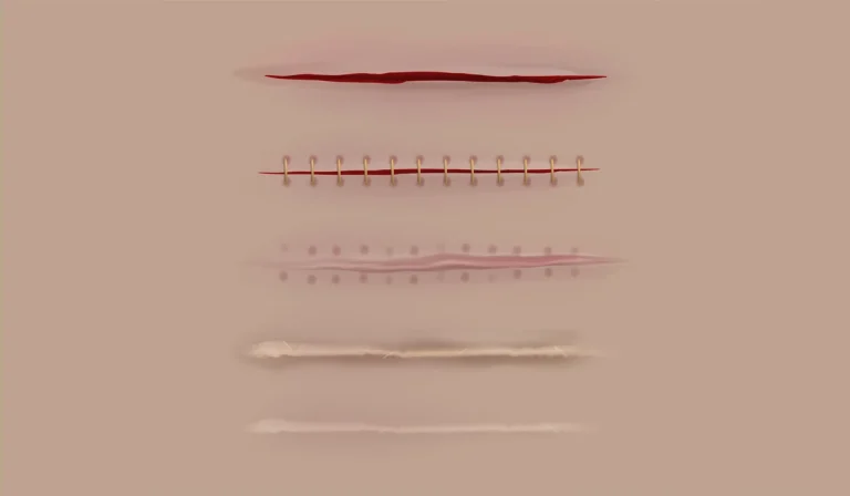 از بین بردن جای بخیه : انواع روش‌های خانگی و حرفه‌ای و تهاجمی