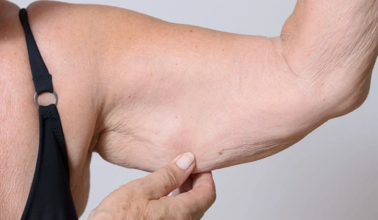 درمان افتادگی پوست بازو : بررسی مهمترین روشها