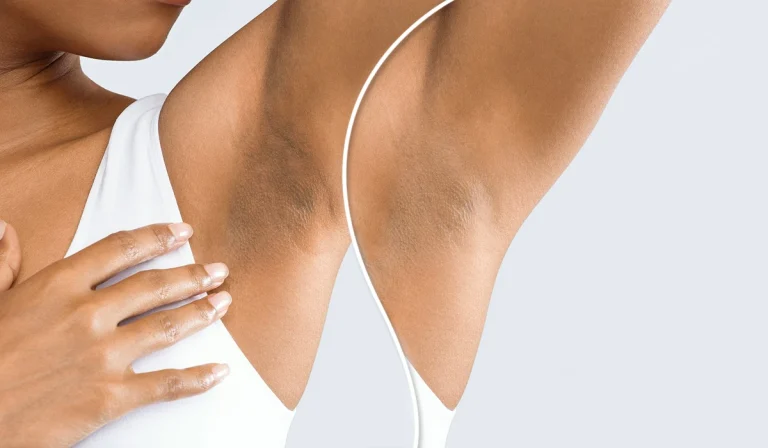 تیرگی زیر بغل : روشهای پیشگیری و درمان