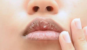 خشکی لب بعد از تزریق ژل : چرا و چگونه درمان می شود؟