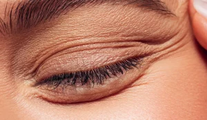 گوشت اضافه بعد از جراحی پلک (اسکار هیپرتروفیک و کلوئید)