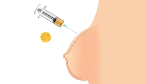 تزریق چربی کنیم یا پروتز سینه؟ کدام روش بهتر است؟