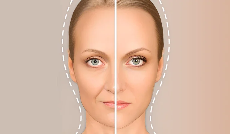 مدت ماندگاری تزریق چربی در صورت و بدن چقدر است؟