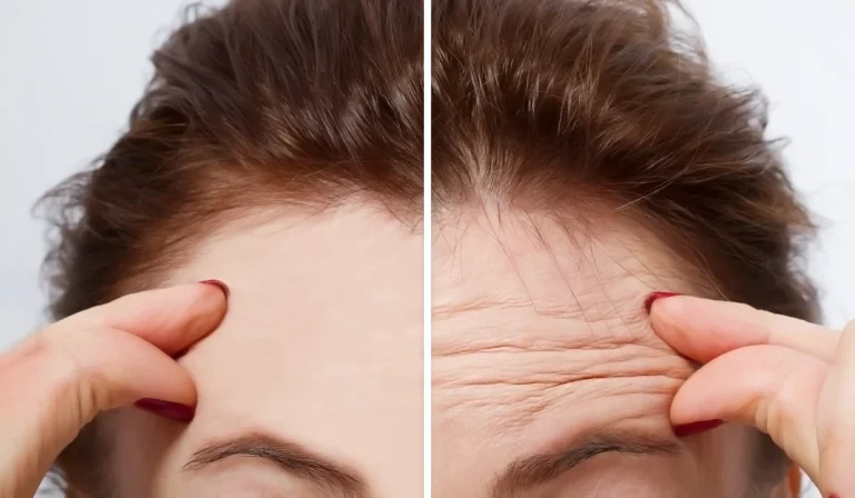 بوتاکس پیشانی : برای کاهش چین و چروک‌ و خطوط افقی