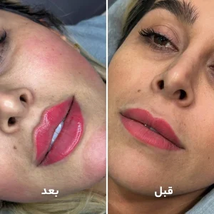 تزریق ژل لب در کلینیک مهرزاد
